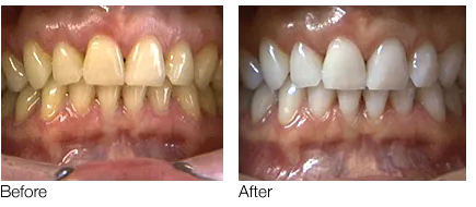 28547 teeth whitening aldridge toothpaste