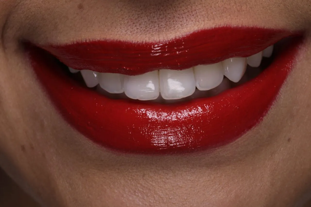 28551 teeth whitening side effects