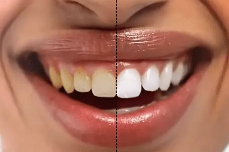 28554 proper whitening strips usage