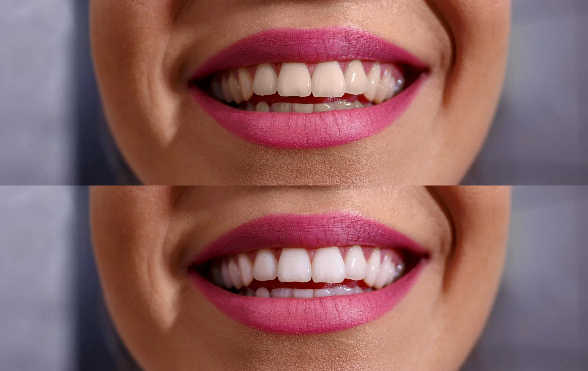 28566 at home teeth whitening