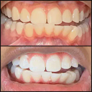 /img/28581-teeth-whitening-lancaster-ca-diy.webp