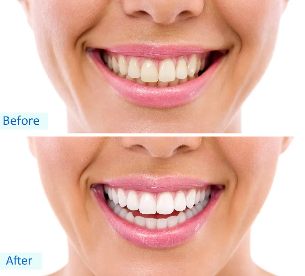 28591 teeth whitening pain image3