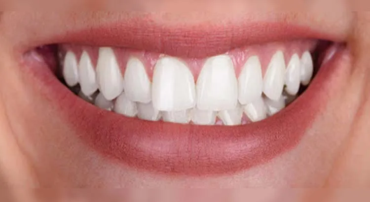 28592 lakewood teeth whitening confidence