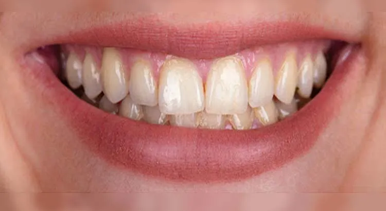 28592 teeth whitening lakewood types