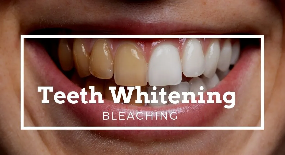 28594 teeth whitening cost