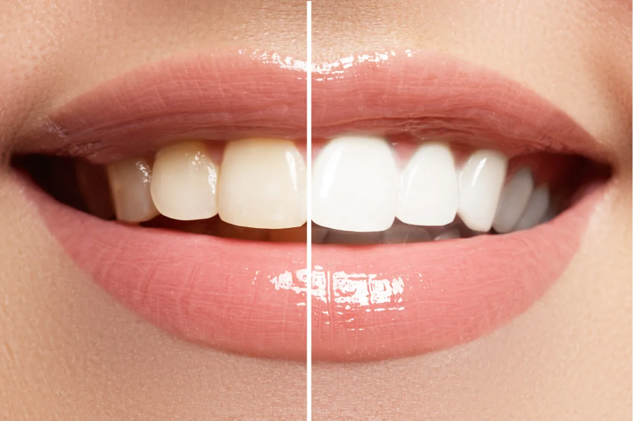 28594 teeth whitening youthful look