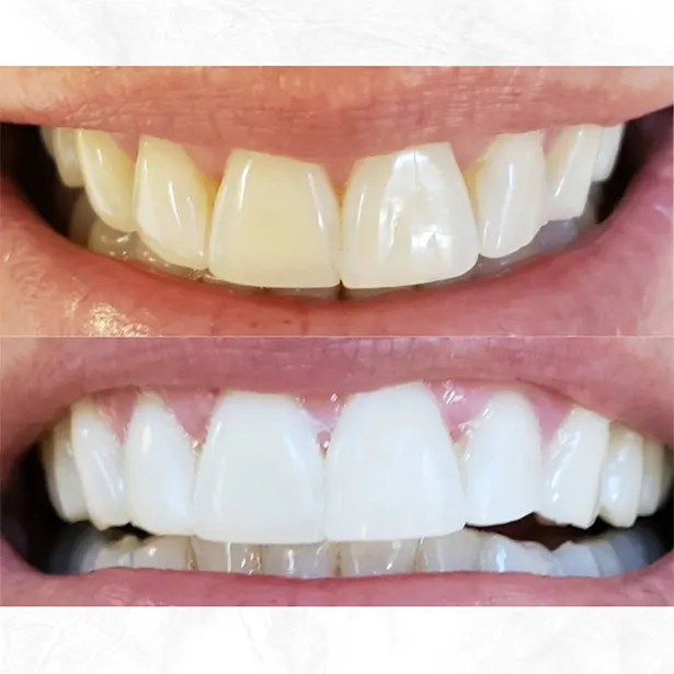 28610 at home teeth whitening