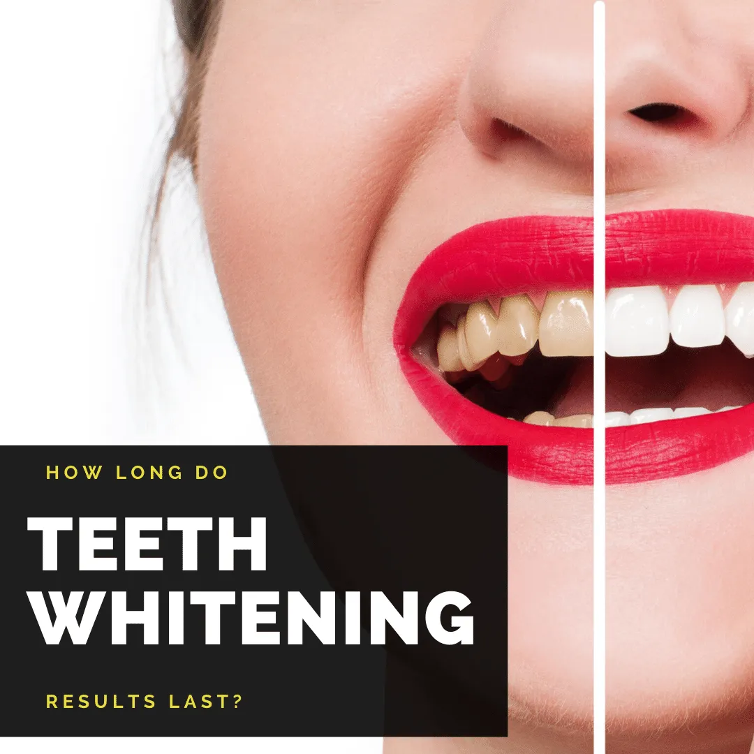 28617 at home teeth whitening