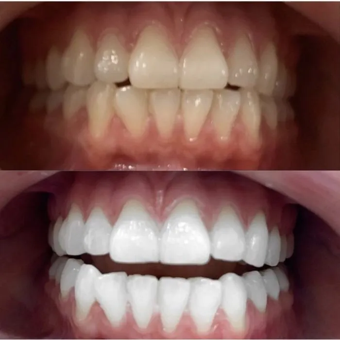 28617 teeth staining foods