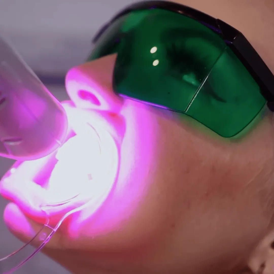 28620 laser teeth whitening before after