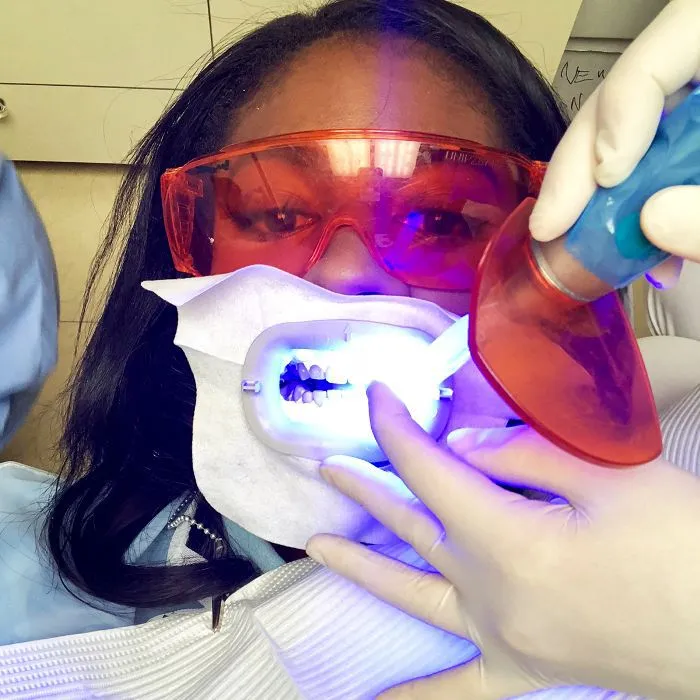 28620 laser teeth whitening results