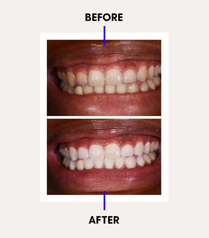 28620 laser teeth whitening science
