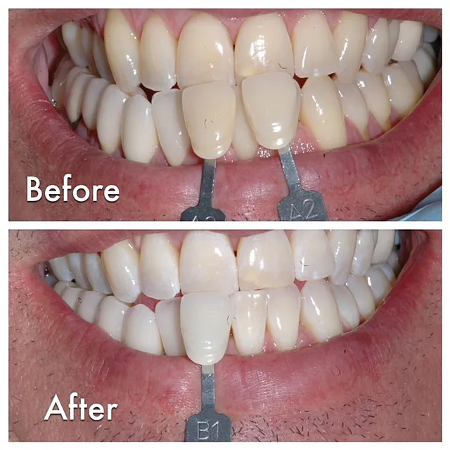 28620 reddit laser teeth whitening clinic