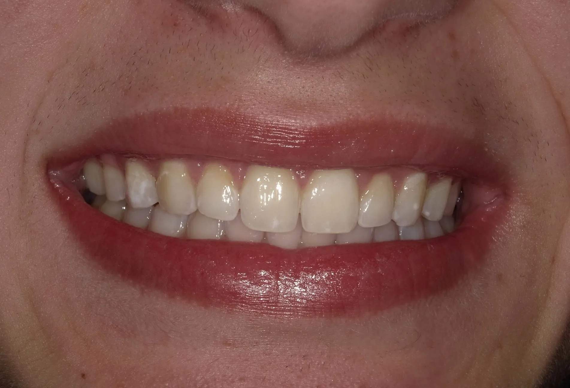 28623 dental bonding and teeth whitening overview