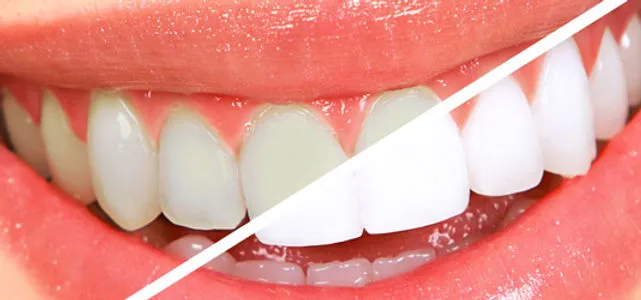 28623 enhanced aesthetics with bonding