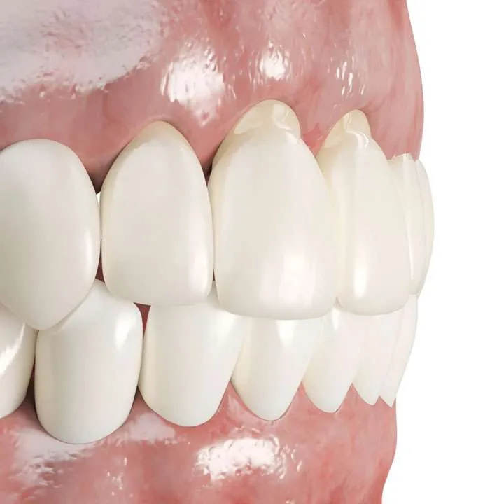 28628 causes of gum recession