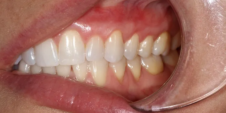 28628 increased sensitivity teeth whitening