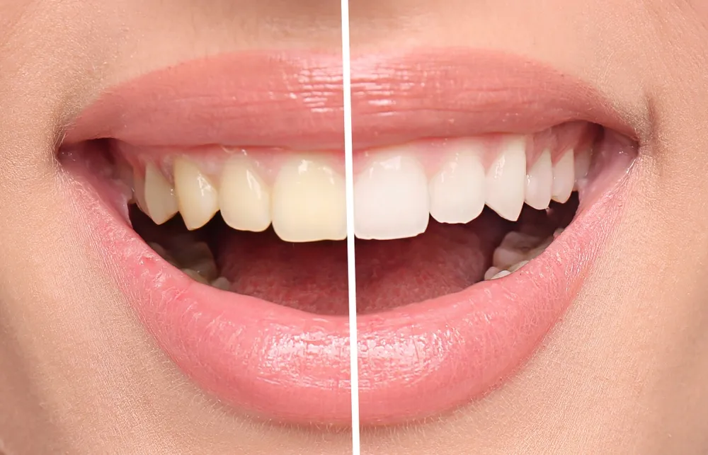 28631 in office teeth whitening