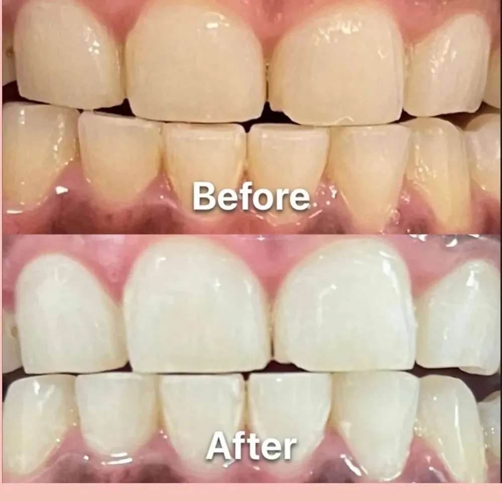 28631 teeth whitening risks