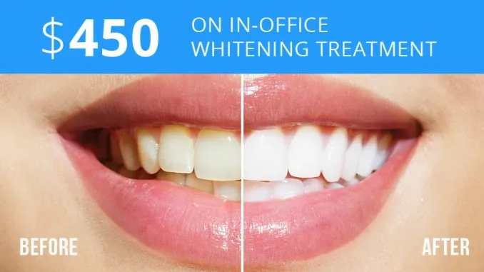 28649 in office teeth whitening