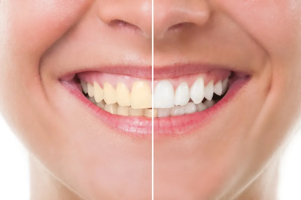 28656 teeth whitening nyc image4