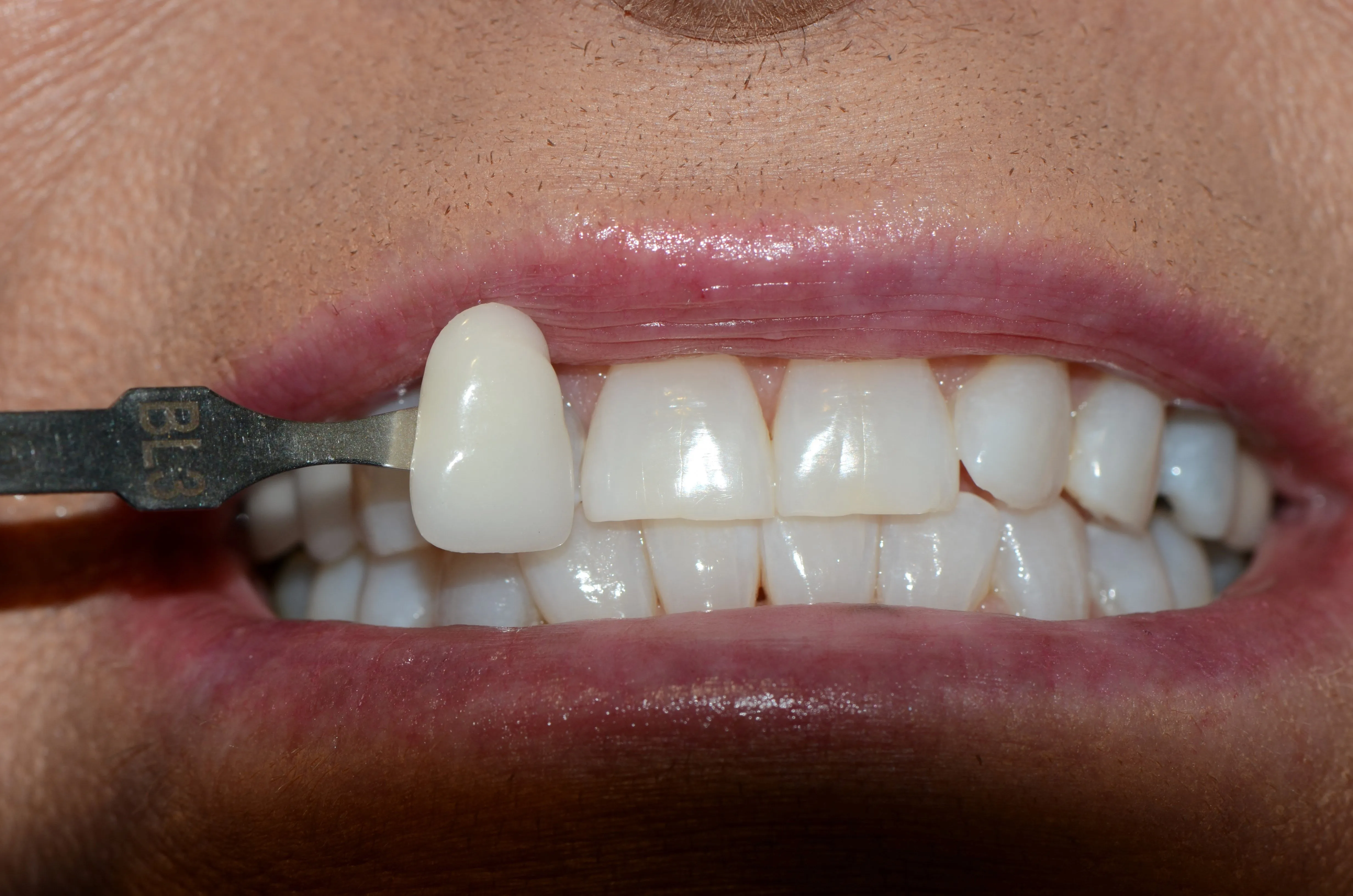 28659 at home teeth whitening