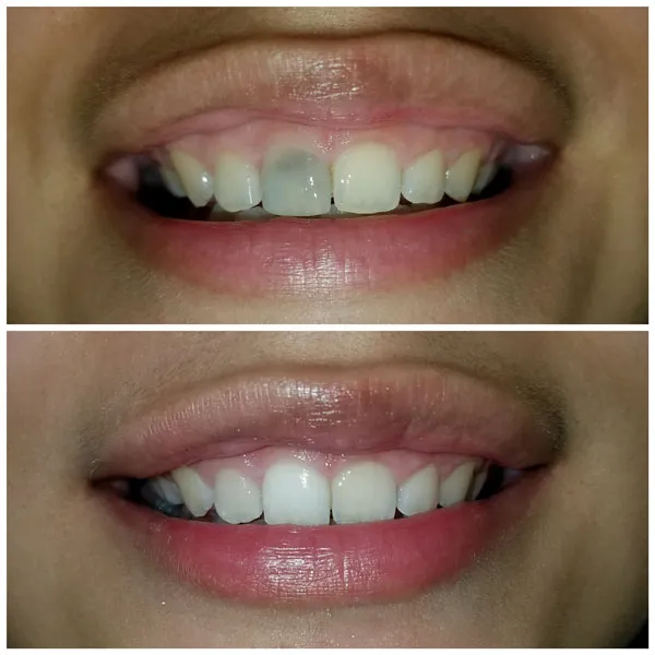 28659 teeth whitening garland