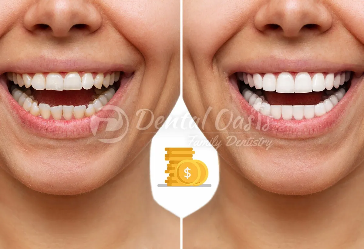 /img/28660-teeth-whitening-maintenance.webp