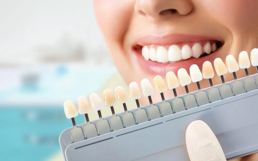 28660 teeth whitening smile