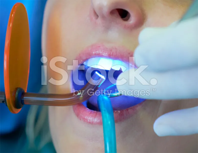 28661 irvine teeth whitening image4