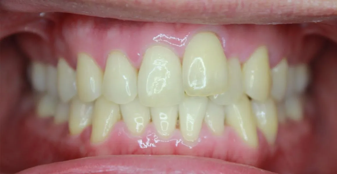 28670 avoid foods teeth whitening