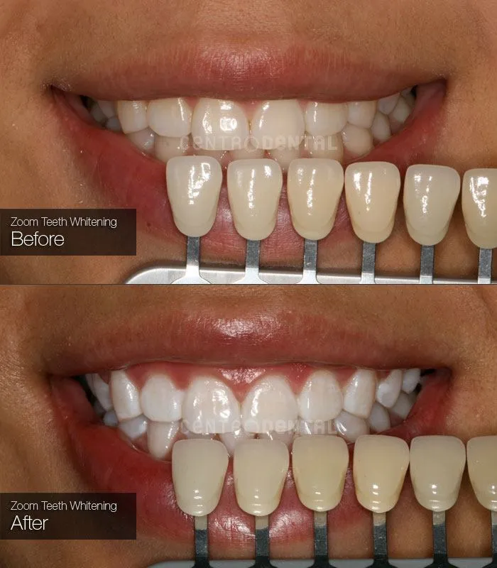 /img/28670-teeth-whitening-results.webp