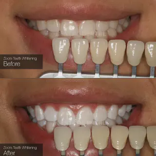 /img/28670-teeth-whitening-results.webp