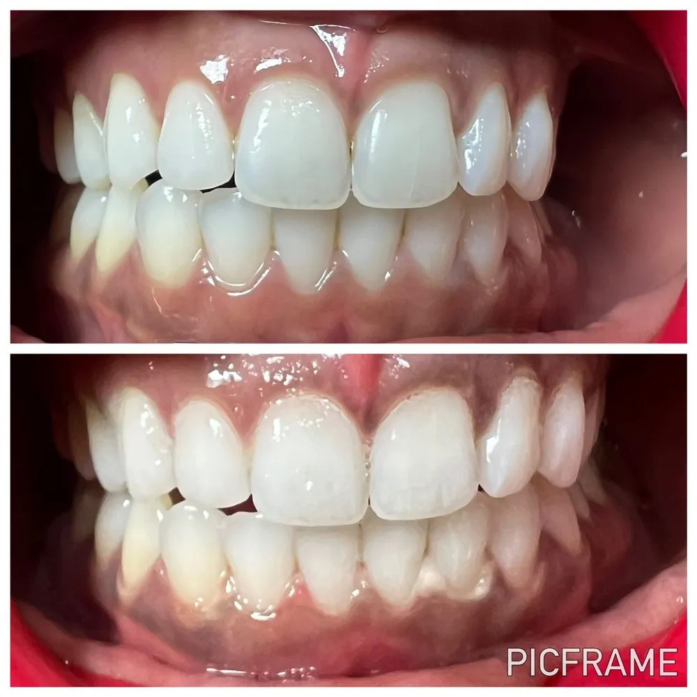 28673 at home teeth whitening