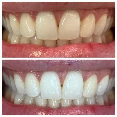 28673 in office teeth whitening