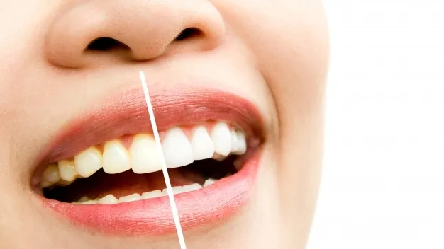 28680 zoom teeth whitening melbourne clinic