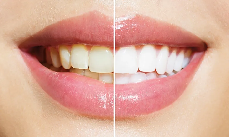 28680 zoom teeth whitening melbourne procedure