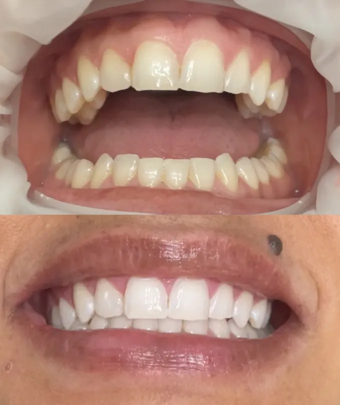 28681 laser teeth whitening san antonio benefit2