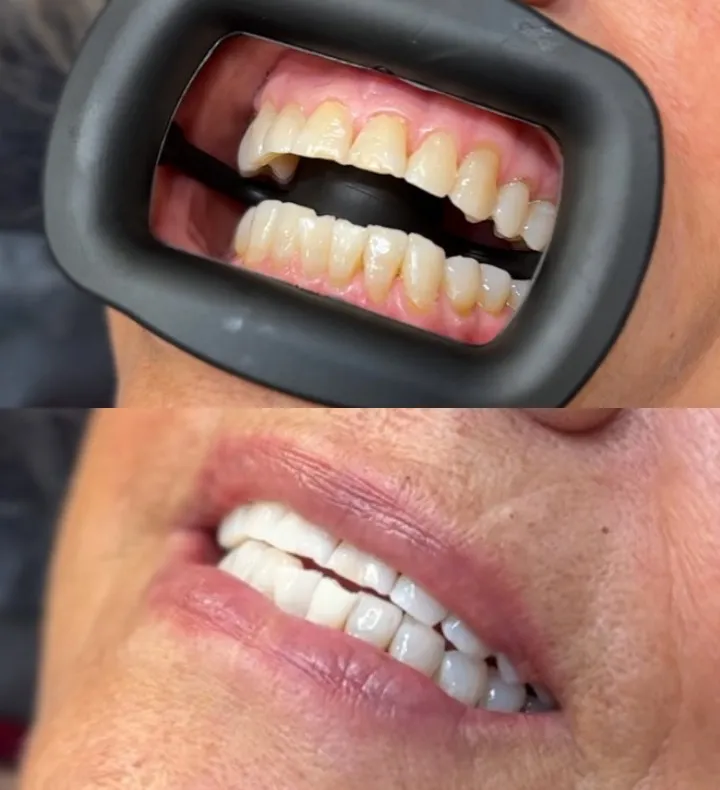 28681 laser teeth whitening san antonio results