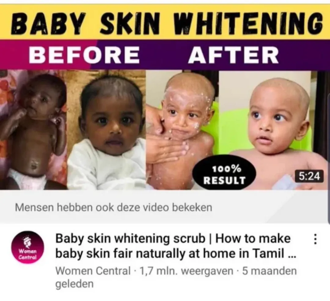 28688 teeth whitening before after