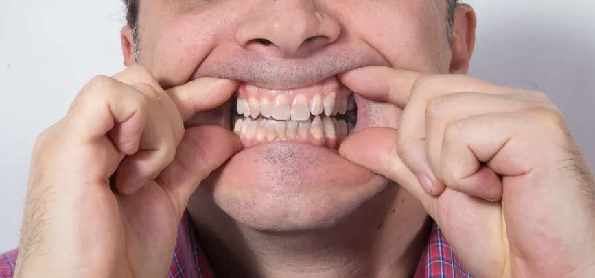 28702 teeth whitening diet