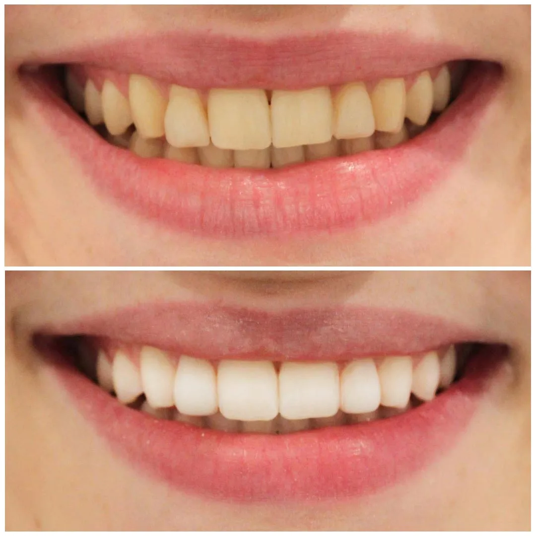 28708 at home teeth whitening
