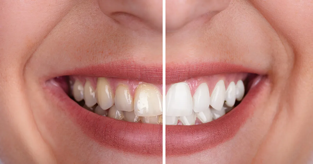 28708 teeth whitening enamel