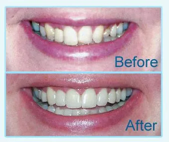 28711 crown material