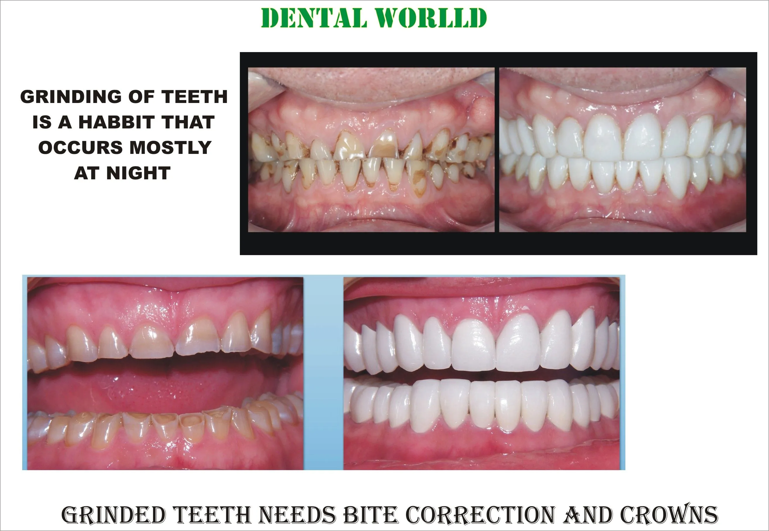 28711 teeth whitening options