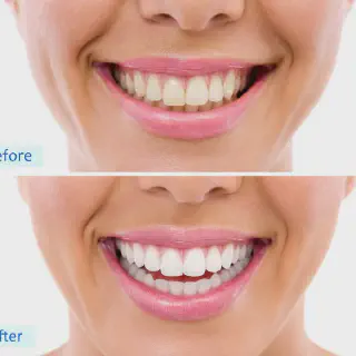 /img/28712-affordable-teeth-whitening.webp
