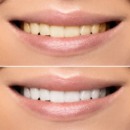 28712 teeth whitening treatment
