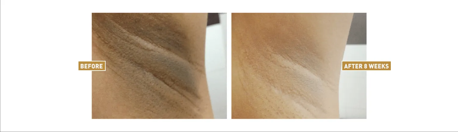 28713 underarm whitening before after