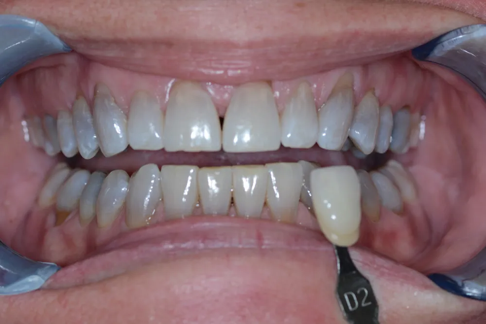 28714 teeth whitening fort wayne in office