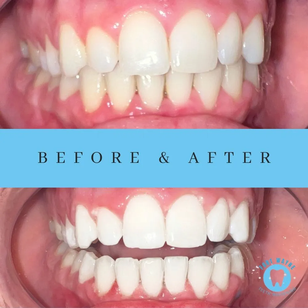 28714 teeth whitening fort wayne professional
